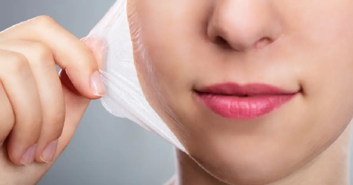 Which Chemical Peel Type Works Best for Acne?
